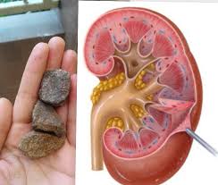 PENYAKIT BATU GINJAL